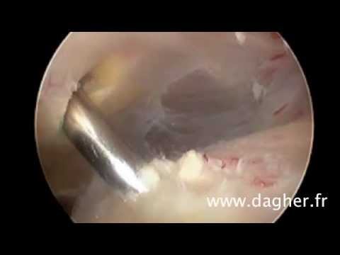 comment traiter calcification