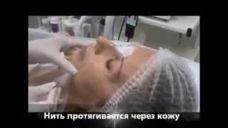 Лифтинг 3D Мезонитями