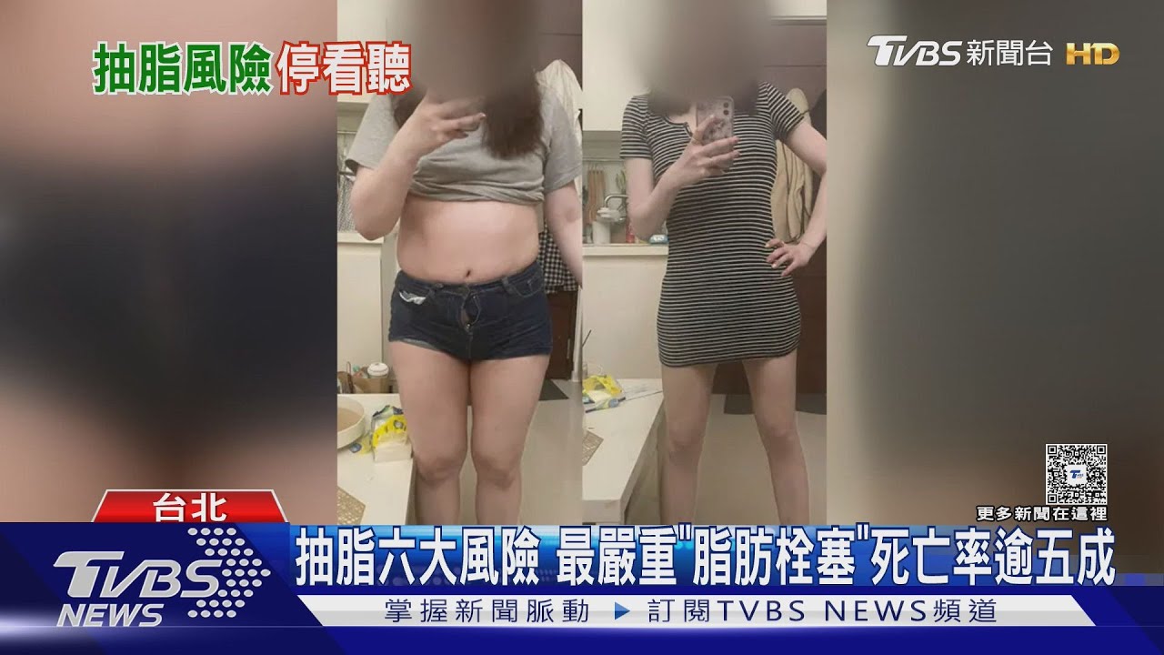 抽脂六大風險 最嚴重「脂肪栓塞」死亡率逾五成