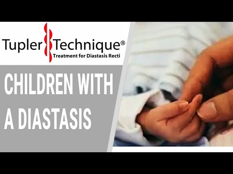 Children With a Diastasis-Julie Tupler, RN