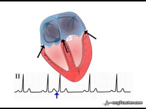 ECGTeacher com   Fusion Section 4  Part 3   YouTube