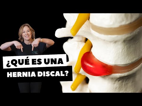 ¿QUÉ ES UNA HERNIA DISCAL?