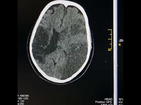 Differences between acute and chronic cerebral infarcts. An undergraduate assistance.