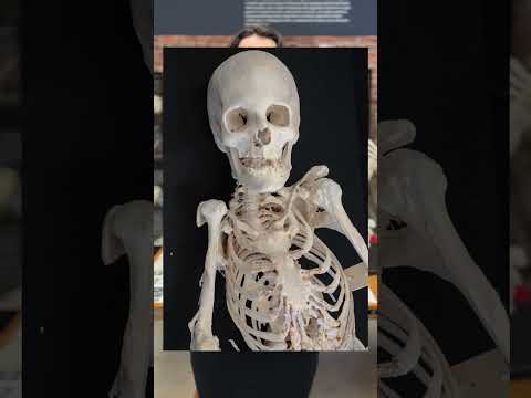 Fibrodysplasia ossificans progressiva (FOP)