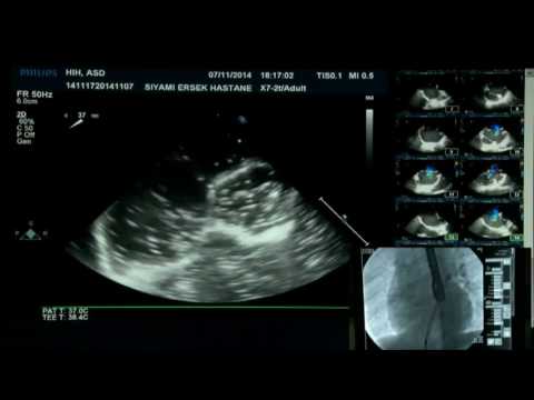 LIVE CASE 8   ASD closure with Cera-Flex ASD  occluder Felix Berger, Abdullah Erdem