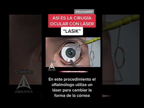 ASÍ ES LA CIRUGÍA OCULAR LASIK - HOW IT’S DONE: LASIK SURGERY