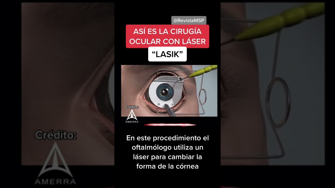 ASÍ ES LA CIRUGÍA OCULAR LASIK - HOW IT’S DONE: LASIK SURGERY