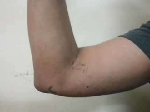 How to palpate epitrochlear lymph nodes. Clinical examination video by SIMPLE Orthopaedics