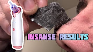 #BlackHead Vacuum Removal with built in camera for #SkinCare