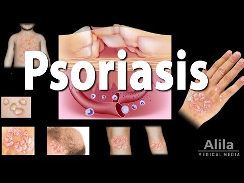 Psoriasis creme schweiz