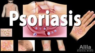 Psoriasis: Types, Symptoms, Causes, Pathology, and Treatment, Animation