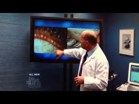 Lipiflow Procedure for Dry Eyes