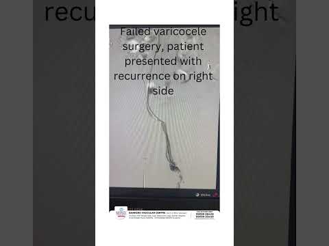 Failed varicocele surgery treated with advanced varicocele embolization at @bankersvascular