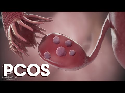 menstruation and  Polycystic Ovary Syndrome or PCOS | Causes |Treatments|Dandelion Medical Animation