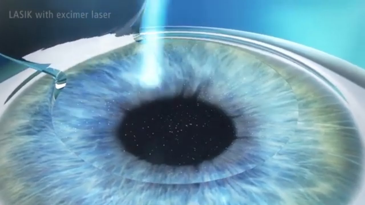 All Laser Refractive Procedures