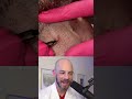 Derm Reacts To Ingrown Hair Pimple Pop Combo Dermreacts Doctorreacts Pimplepop Ingrownhair