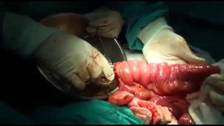 Removal operation intestinal worms parasites from human