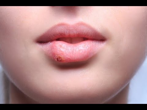Malattia demielinizzante del rachide cervicale Perché per un lungo periodo si fa male alla spalla