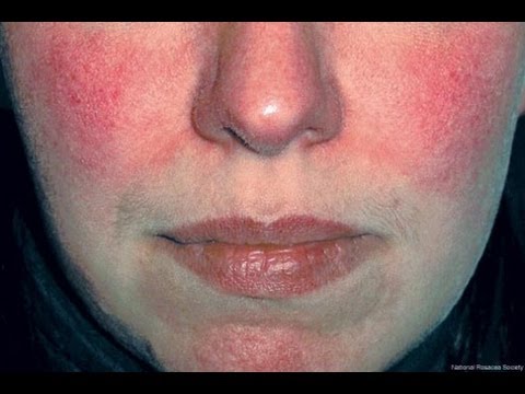 DermTV - Rosacea [DermTV.com Epi #444]