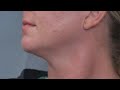 New Re-Jaw-Venation Procedure Lifts Jowls Instantly?