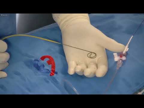 TAVI For Severe AS Using A 29 MM Evolut PRO