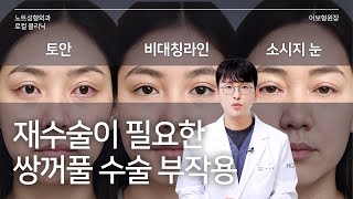 [이보형 원장의 Q&A] 이거 무조건 재수술이죠? l 쌍꺼풀 부작용 l 쌍꺼풀 재수술 l 자가 진단법 l