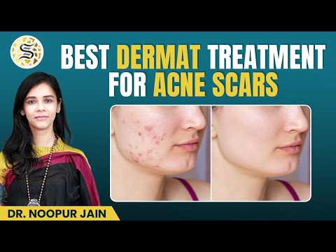 Are You Treating Acne Scars Wrong? Dermatologist Explains | Skinzest