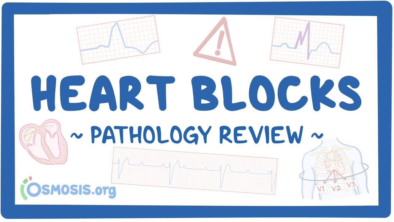 Heart blocks: Pathology Review