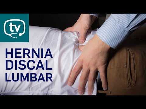 Hernia discal lumbar, ¿qué debes saber?