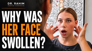 CAR ACCIDENT Left Her With Neck Pain, Headaches & Facial Swelling 😳