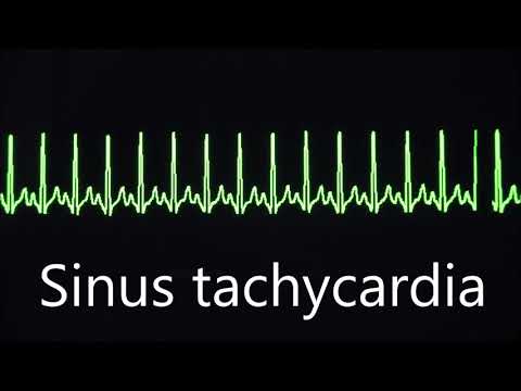 Sinus rhythm, bradycardia and tachycardia