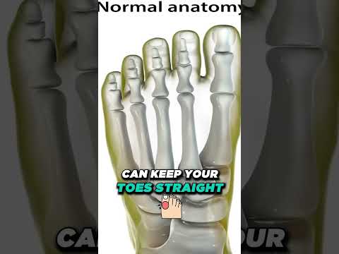 What Causes Bunions What is a bunion How Do You Get Bunions