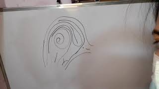Accidental Whorl