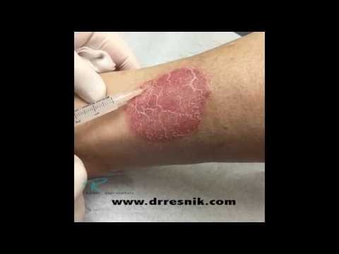 Mal di schiena dà ad una gamba e al collo Spalla lesioni tendinite congiunta