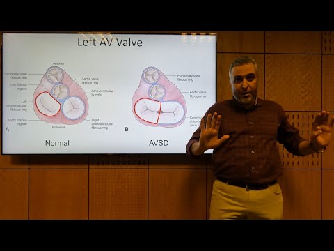 AVSD (AV Canal) - Hatem Hosny (2022)