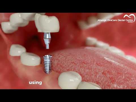 🌟 Restore Your Smile with Dental Implants at Jehangir Oracare Dental Centre! 🌟