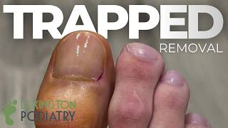 TRAPPED Nail Removal