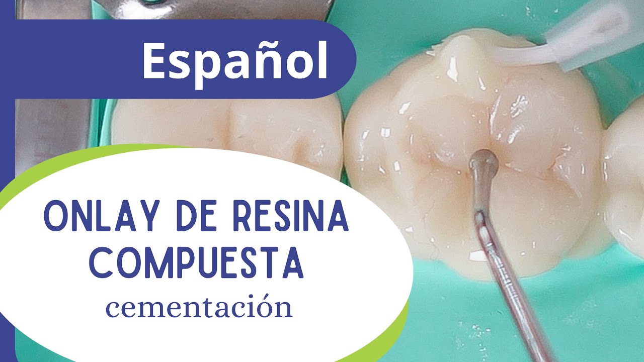 Onlay de resina compuesta - parte 5 final: cementación.