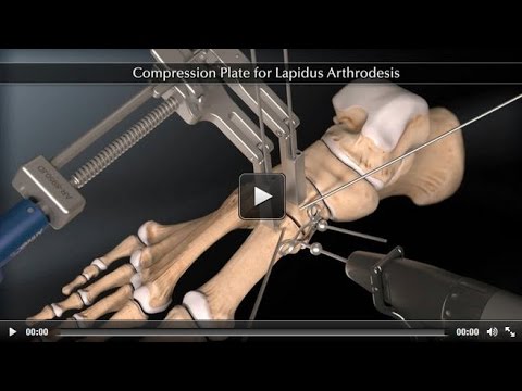 Schwellung der Hüftgelenke Video Übungen für Osteoarthritis des Knies