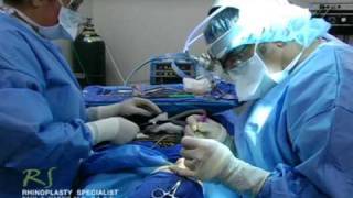 OR Video Footage: Turbinoplasty for Revision Rhinoplasty