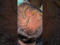 Leechtherapy Ayurveda Modi Cupping New Narendramodi Hot Navel