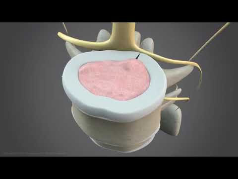 How nonsurgical spinal decompression works