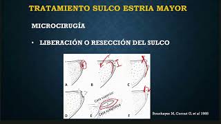 Fonocirugía en Sulcus Vocalis con la Dra. Mónica Saavedra Ortega