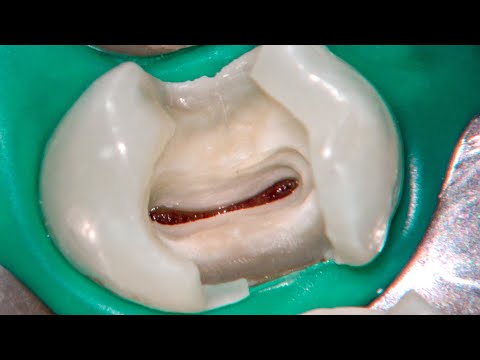 Partial pulpotomy in two maxillary premolars. Domenico Ricucci.