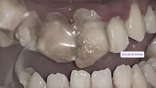 Can You Watch Till the End? Top 3 Most Impressive  Tartar Removals!