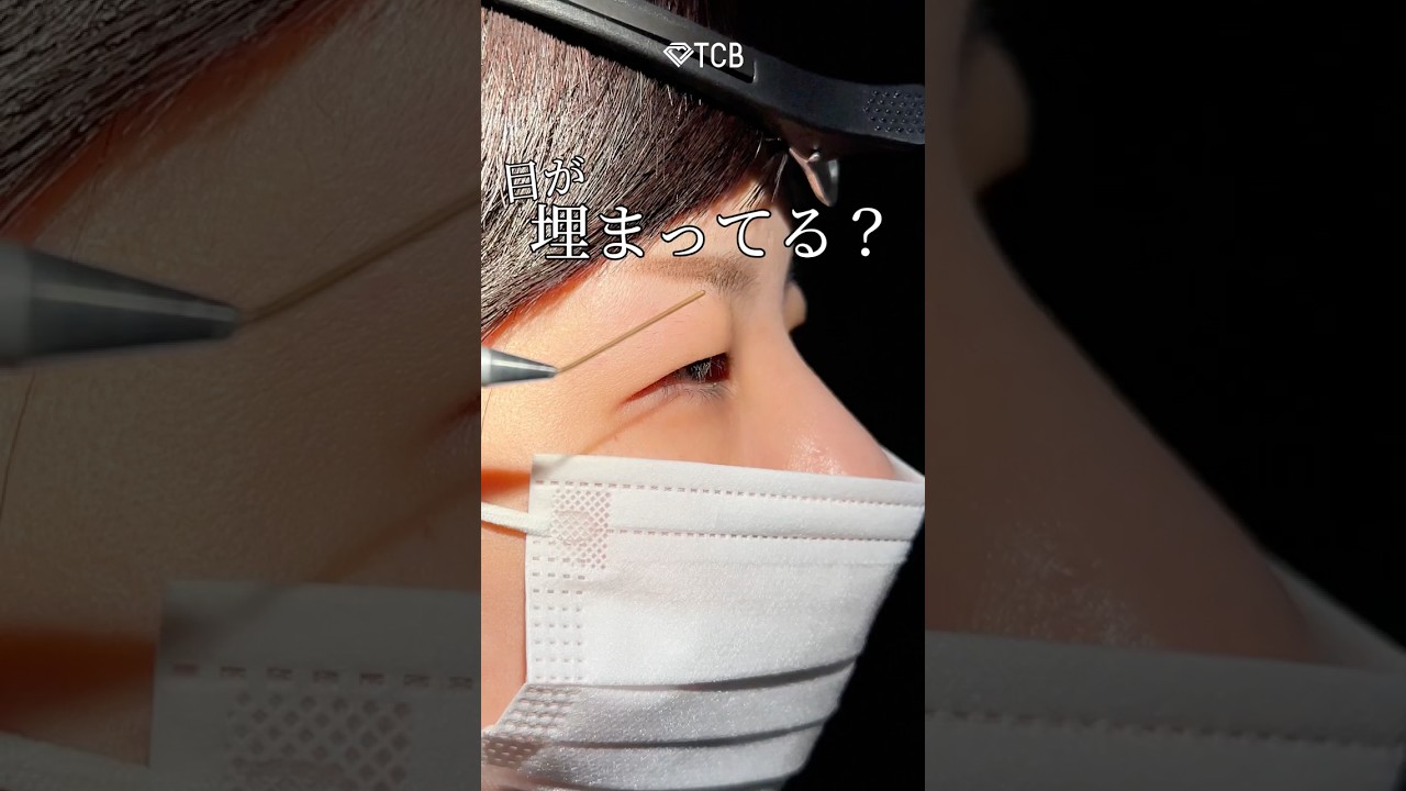 【二重整形】目が埋まってる？#shorts