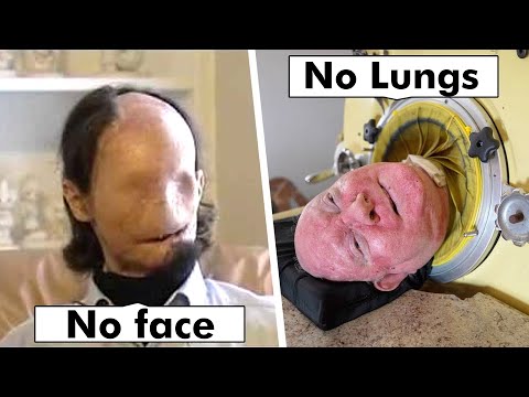 12 Unique People With Missing Body Parts