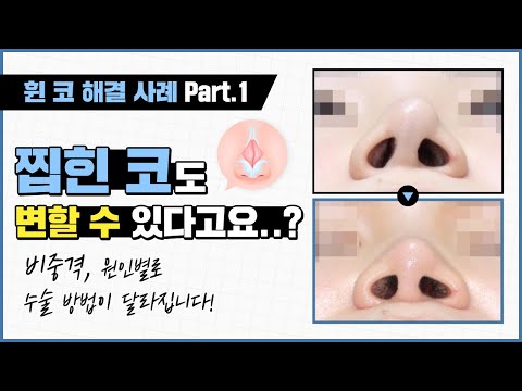 휜 코 교정 원인 별로 교정 가능합니다! ✅ "찝힌 코" 고민도 해결 가능