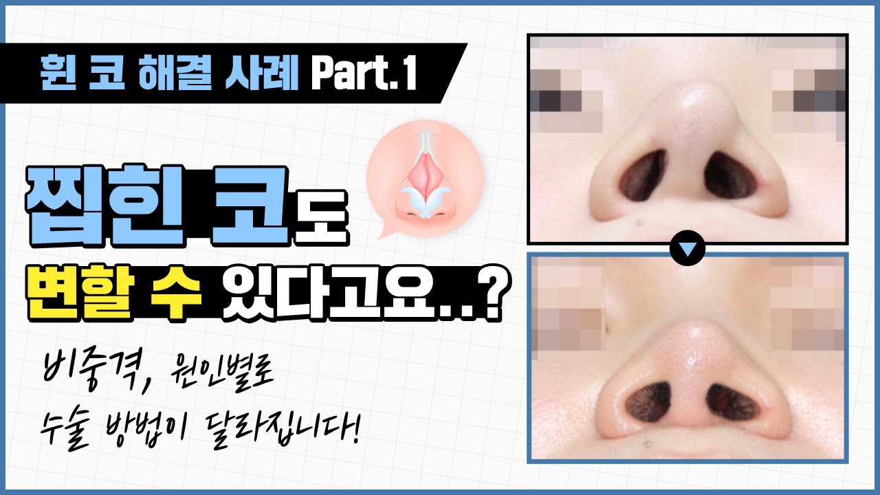 휜 코 교정 원인 별로 교정 가능합니다! ✅ "찝힌 코" 고민도 해결 가능 썸네일
