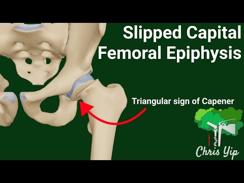 Slipped Capital Femoral Epiphysis + X-Rays Explained (Animated)